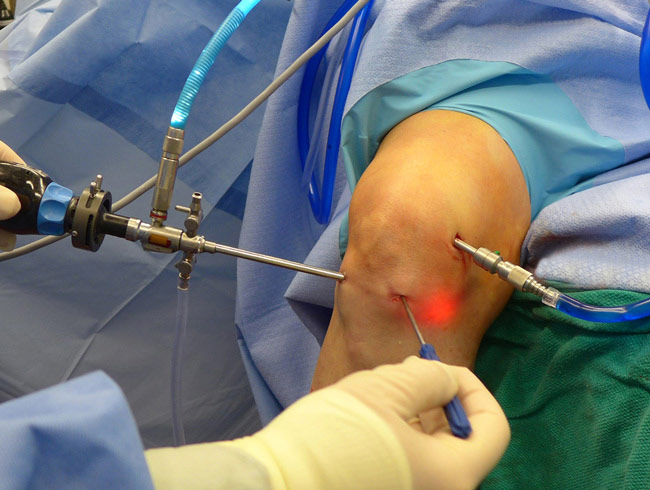 arthroscopy knee surgery
