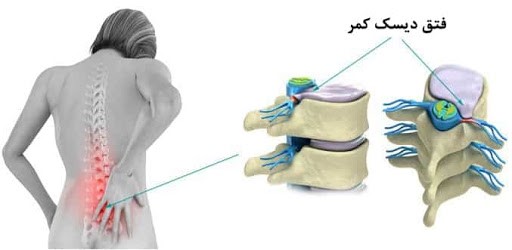 آرتروز کمر