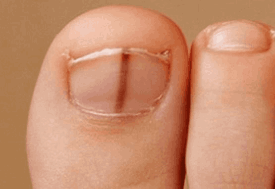 علت خط سیاه روی ناخن پا چیست؟