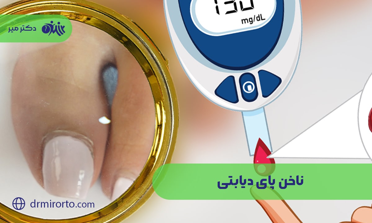 ناخن پای دیابتی