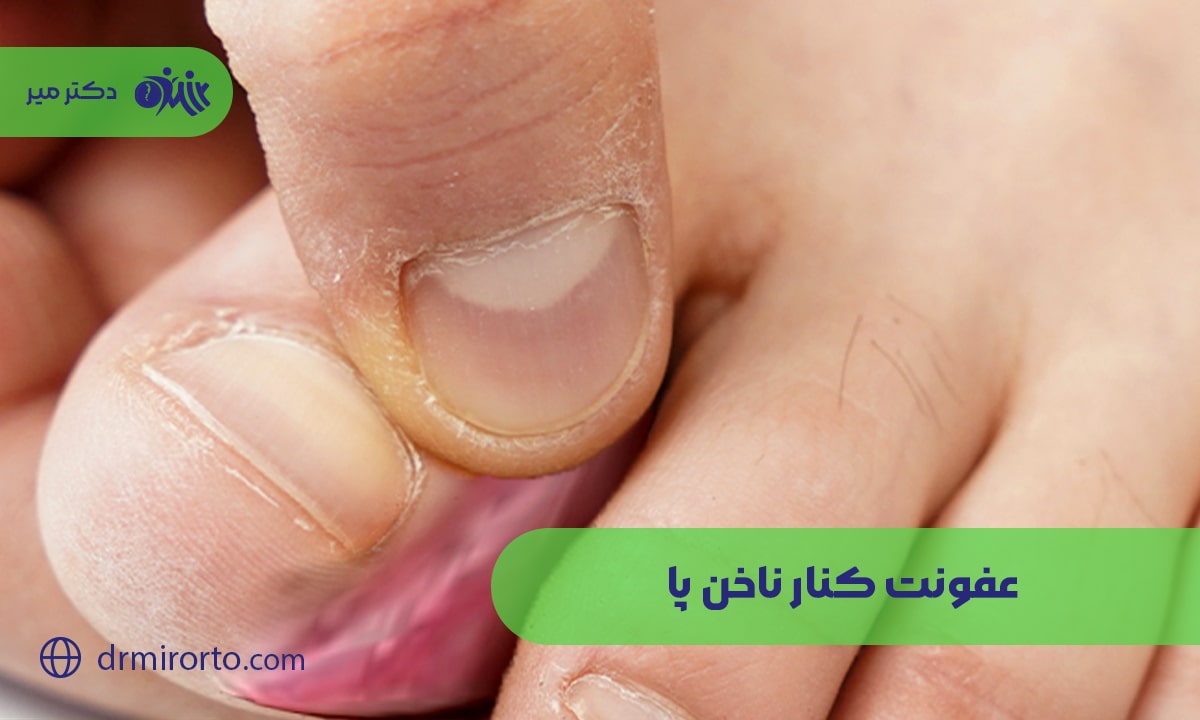 عفونت کنار ناخن پا