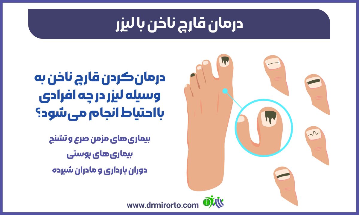 درمان قارچ ناخن با لیزر 