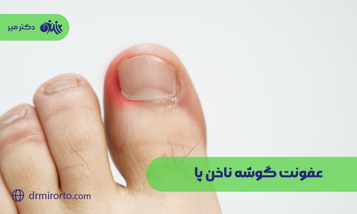 عفونت گوشه ناخن پا