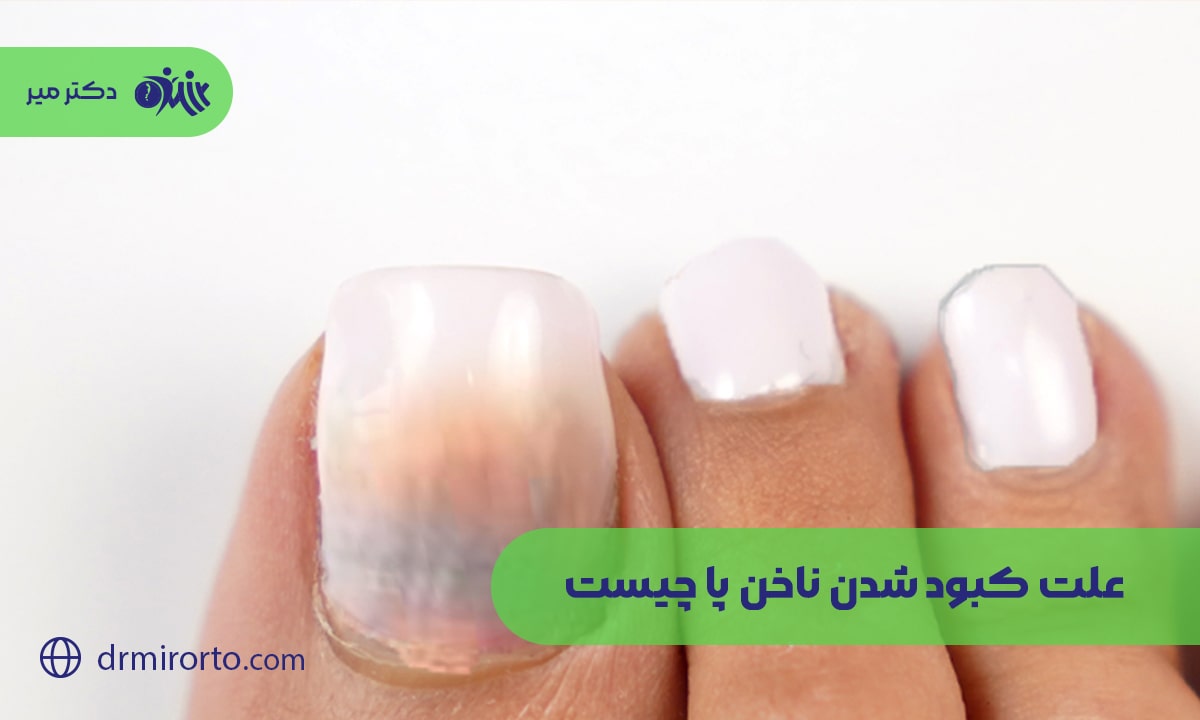 علت کبود شدن ناخن پا چیست