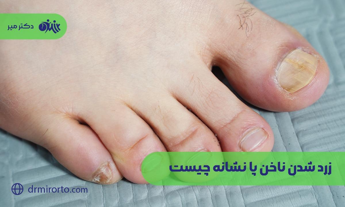 زرد شدن ناخن پا نشانه چیست