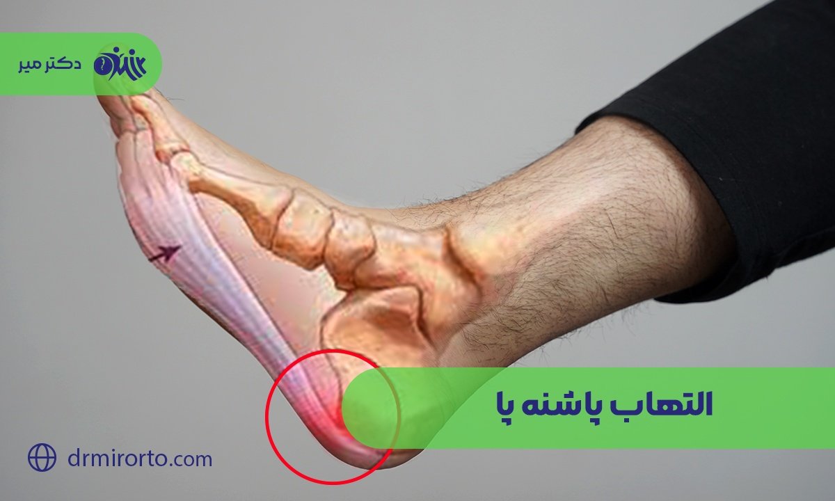  التهاب پاشنه پا